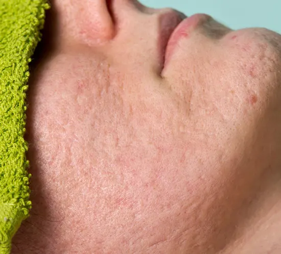 Acne Scar Peels