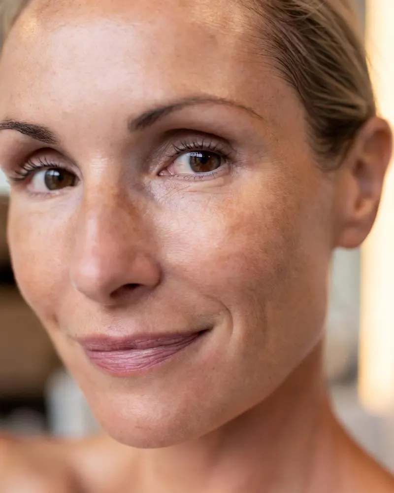 Woman in her early 40s representing chemical peel care for fine lines, melasma, and sun-damaged skin.