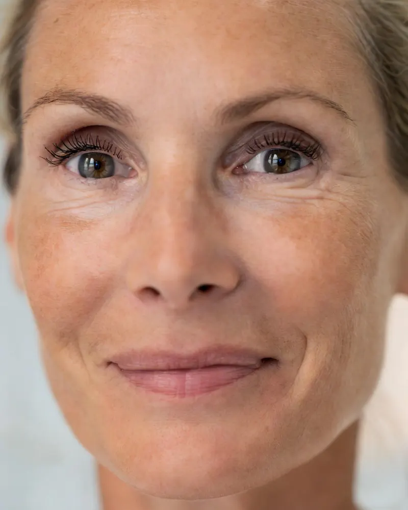 Woman in her early 50s representing chemical peel care for wrinkles, elasticity loss, and photoaging.